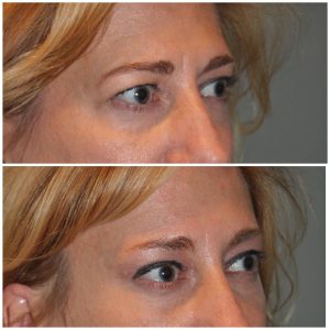50 year old female 1 month following an endoscopic brow lift and upper eyelid blepharoplasty.