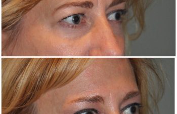 50 year old female 1 month following an endoscopic brow lift and upper eyelid blepharoplasty.