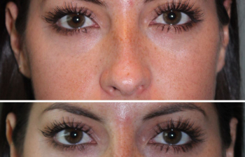 26 year old female following a liquid rhinoplasty nonsurgical nose job to camouflage the bump on her nose.