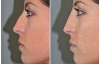 26 year old female following a liquid rhinoplasty nonsurgical nose job to camouflage the bump on her nose.
