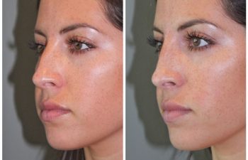 26 year old female following a liquid rhinoplasty nonsurgical nose job to camouflage the bump on her nose.