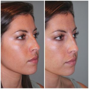 26 year old female following a liquid rhinoplasty nonsurgical nose job to camouflage the bump on her nose.