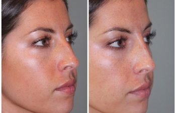 26 year old female following a liquid rhinoplasty nonsurgical nose job to camouflage the bump on her nose.