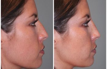 26 year old female following a liquid rhinoplasty nonsurgical nose job to camouflage the bump on her nose.