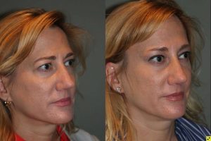 50 year old female 1 month following an endoscopic brow lift and upper eyelid blepharoplasty.