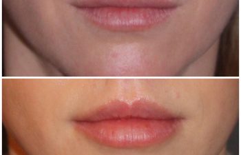 33 year old female 2 months post op from a modified upper lip lift