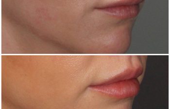 33 year old female 2 months post op from a modified upper lip lift