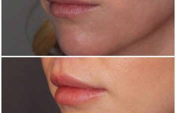 33 year old female 2 months post op from a modified upper lip lift