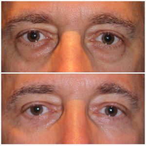 male patient before and after lower eyelid blepharoplasty