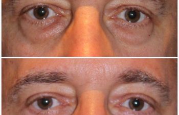 male patient before and after lower eyelid blepharoplasty