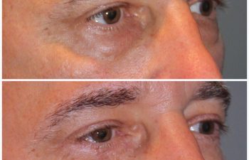 male patient before and after lower eyelid blepharoplasty