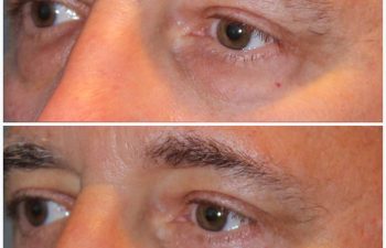 male patient before and after lower eyelid blepharoplasty