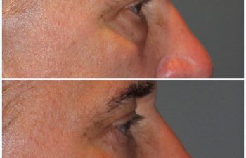 male patient before and after lower eyelid blepharoplasty