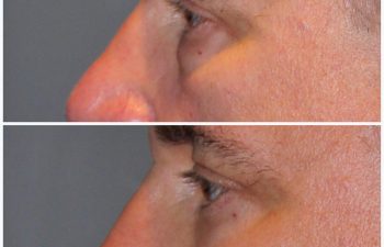 male patient before and after lower eyelid blepharoplasty