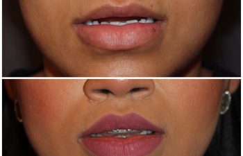 26 year old female 2 months post op from modified upper lip lift.