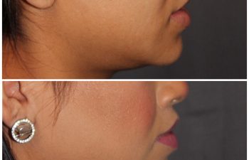 26 year old female 2 months post op from modified upper lip lift.