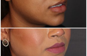 26 year old female 2 months post op from modified upper lip lift.