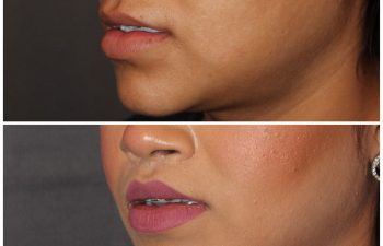 26 year old female 2 months post op from modified upper lip lift.