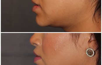 26 year old female 2 months post op from modified upper lip lift.