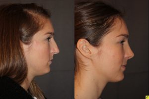 26 year old female 1 month postop from cosmetic rhinoplasty