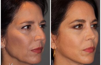 51 year old female 8 months post op from a cosmetic rhinoplasty and an extended mini deep plane facelift Kaloslift.