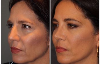 51 year old female 8 months post op from a cosmetic rhinoplasty and an extended mini deep plane facelift Kaloslift.