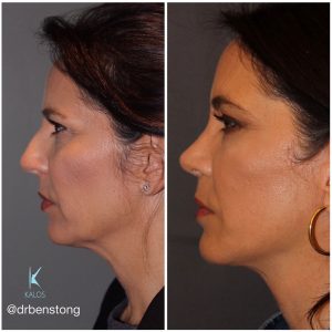 51 year old female 8 months post op from a cosmetic rhinoplasty and an extended mini deep plane facelift Kaloslift.