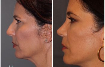 51 year old female 8 months post op from a cosmetic rhinoplasty and an extended mini deep plane facelift Kaloslift.