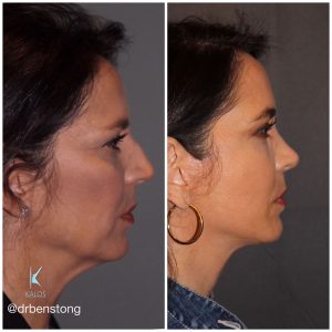 51 year old female 8 months post op from a cosmetic rhinoplasty and an extended mini deep plane facelift Kaloslift.