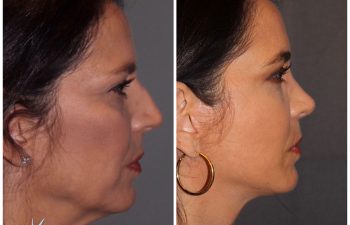 51 year old female 8 months post op from a cosmetic rhinoplasty and an extended mini deep plane facelift Kaloslift.
