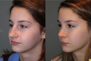 Rhinoplasty - 14 year old female 5 months post op from a rhinoplasty to tighten the tip, shorten the nose, elevate the tip, and remove the hump.