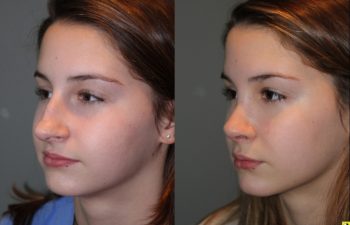 Rhinoplasty - 14 year old female 5 months post op from a rhinoplasty to tighten the tip, shorten the nose, elevate the tip, and remove the hump.