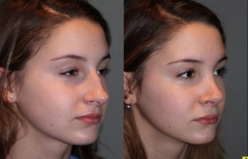 Rhinoplasty - 14 year old female 5 months post op from a rhinoplasty to tighten the tip, shorten the nose, elevate the tip, and remove the hump.