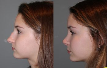 Rhinoplasty - 14 year old female 5 months post op from a rhinoplasty to tighten the tip, shorten the nose, elevate the tip, and remove the hump.