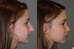 Rhinoplasty - 14 year old female 5 months post op from a rhinoplasty to tighten the tip, shorten the nose, elevate the tip, and remove the hump.