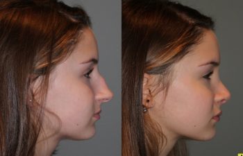 Rhinoplasty - 14 year old female 5 months post op from a rhinoplasty to tighten the tip, shorten the nose, elevate the tip, and remove the hump.