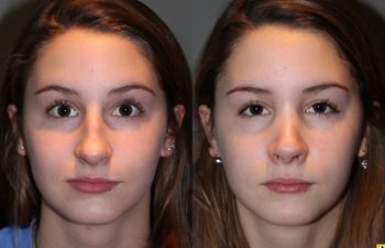 Rhinoplasty - 14 year old female 5 months post op from a rhinoplasty to tighten the tip, shorten the nose, elevate the tip, and remove the hump.