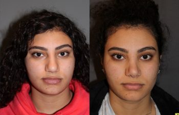 Cosmetic Rhinoplasty - 17 year old female 4.5 months post op from a cosmetic rhinoplasty
