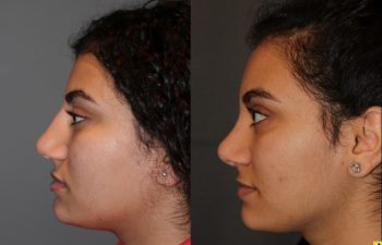Cosmetic Rhinoplasty - 17 year old female 4.5 months post op from a cosmetic rhinoplasty