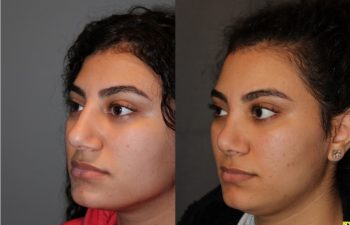 Cosmetic Rhinoplasty - 17 year old female 4.5 months post op from a cosmetic rhinoplasty