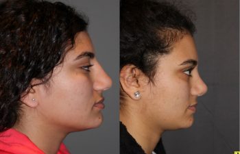 Cosmetic Rhinoplasty - 17 year old female 4.5 months post op from a cosmetic rhinoplasty