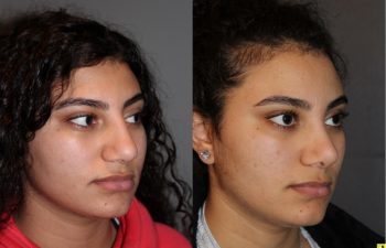 Cosmetic Rhinoplasty - 17 year old female 4.5 months post op from a cosmetic rhinoplasty