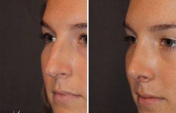 26 year old female 1 month postop from cosmetic rhinoplasty