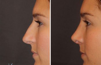 26 year old female 1 month postop from cosmetic rhinoplasty