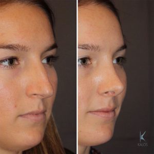 26 year old female 1 month postop from cosmetic rhinoplasty