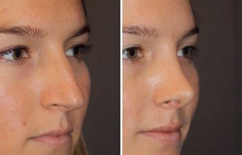 26 year old female 1 month postop from cosmetic rhinoplasty