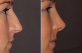 26 year old female 1 month postop from cosmetic rhinoplasty