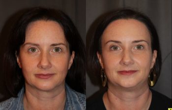 45 year old female three months following Profound RF microneedling to the cheeks and upper neck/chin.