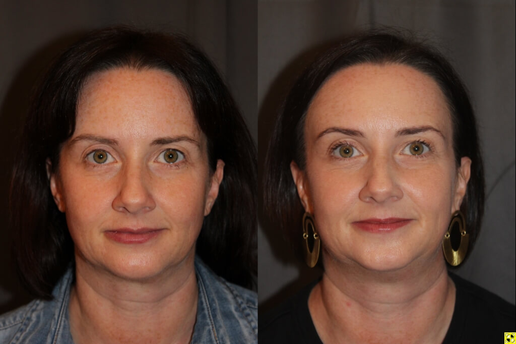 Microneedling Under the Eyes: Procedure, Cost, and More