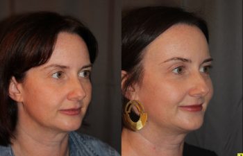 45 year old female three months following Profound RF microneedling to the cheeks and upper neck/chin.